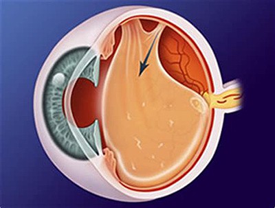 apokolisi-laser-ophthalmos