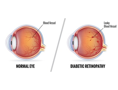 diabetic eye laser ophthalmos