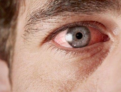 glafkoma-laser-ophthalmos