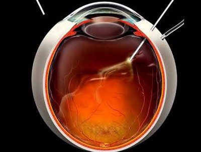 ialodiaktetomi-laser-ophthalmos
